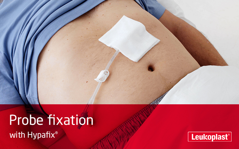 This video shows how to secure a probe with the help of Hypafix stretch medical tape: We see the hands of an HCP attaching a probe to a patient's abdomen. This video shows how to secure a probe with the help of Hypafix stretch medical tape: We see the hands of an HCP attaching a probe to a patient's abdomen.